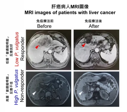 HKUMed discovers gut bacterium impairing liver cancer immunotherapy, advocating for modulation therapy to enhance efficacy