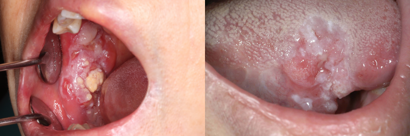 HKU Faculty of Dentistry launches world’s first AI-powered clinic for early oral cancer detection