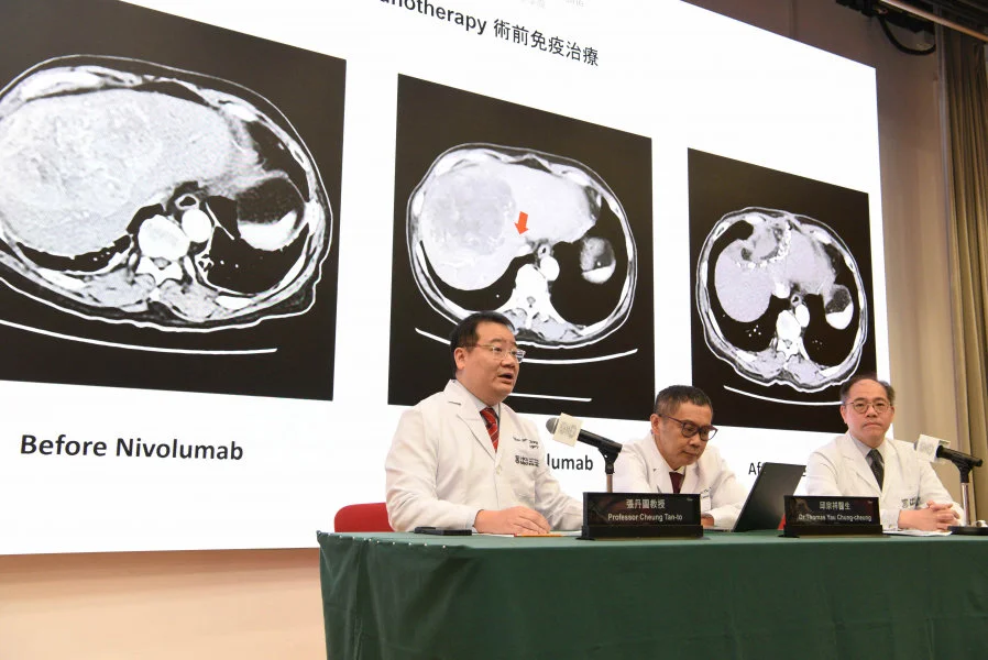 Following the significant effects of the ‘dual immunotherapy’, the new combination treatment has been approved from the FDA, EMA and NMPA for previously untreated advanced HCC patients. The research team includes (from left) Professor Cheung Tan-to, Dr Thomas Yau Chung-cheung and Dr Ronald Leung Ching-yu.  