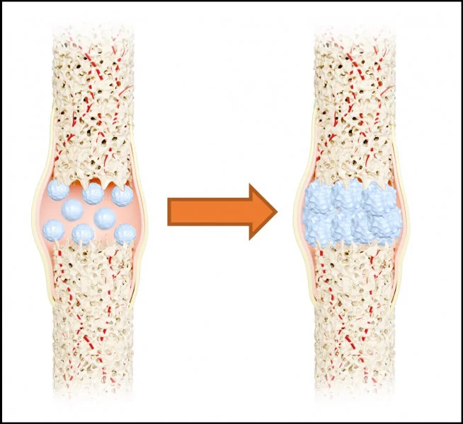The 'nano-artificial bone material', which closely resembles human bone, exhibits exceptional elasticity, toughness and strength. It can provide stability and promote bone healing.  
