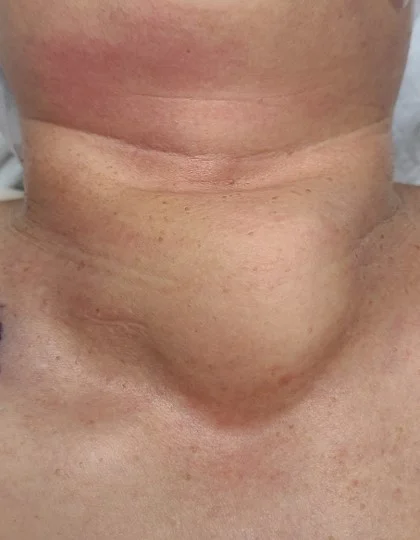 Thyroid cancer is among the most prevalent cancers in Hong Kong and the world. Precision management requires accurate disease staging and clinical risk stratification. This process is currently done manually by doctors who would have to go through a large volume of complex clinical information, which could be time consuming.  