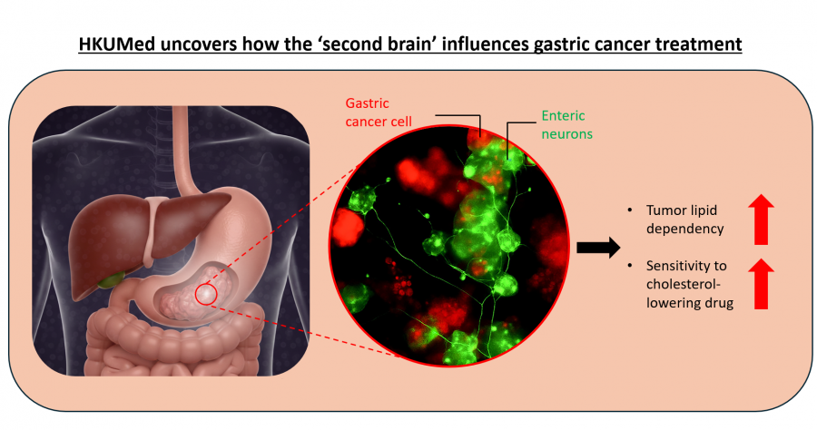 HKUMed researchers have developed a model to simulate the interaction between enteric neurons and gastric cancer tumours. The results revealed elevated fatty acid metabolism levels within cancer cells, indicating heightened lipid dependency. The use of cholesterol inhibitors significantly enhanced the efficacy of killing cancer cells by 6.3 times.  