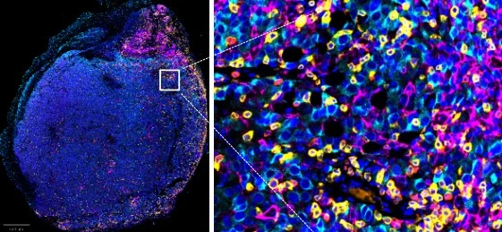 AOAH not only demonstrates standalone therapeutic potential but also functions as a powerful complement to existing immunotherapies, providing a promising strategy to overcome immune resistance in advanced cancers by potentiating infiltration and activation of CD8+ T cells and CD11c+ dendritic cells.  