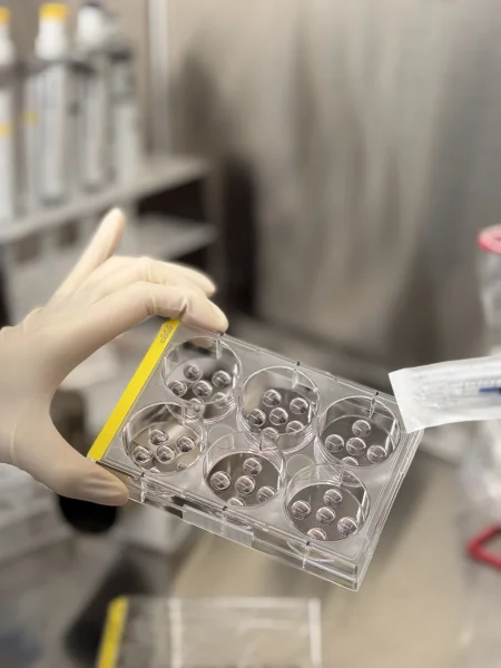 The HKUMed research team grew a collection of 70 organoids from tissue samples of cancer patients at Queen Mary Hospital, providing a realistic model for studying the progression of intestinal metaplasia to cancer.  