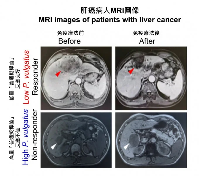 HKUMed researchers discovered that transplanting the gut bacterium Phocaeicola vulgatus into mouse models of liver cancer induced immunotherapy resistance. The finding in mice is consistent with clinical observations in patients, as illustrated by the representative MRI scans, showing that patients with low levels of Phocaeicola vulgatus responded better to treatment.